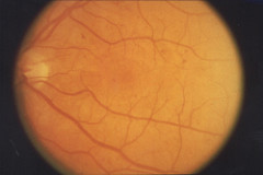 background retinopathy