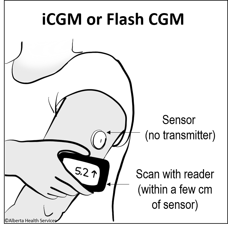 intermittent cgm