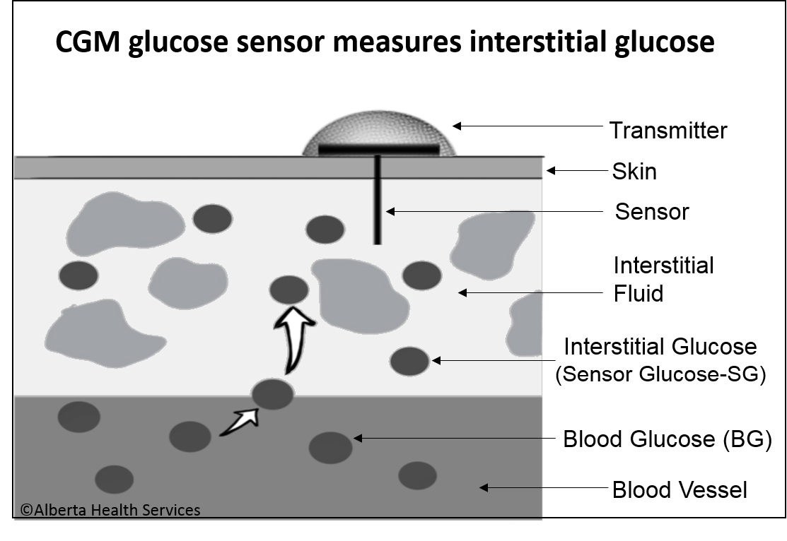 CGM sensor