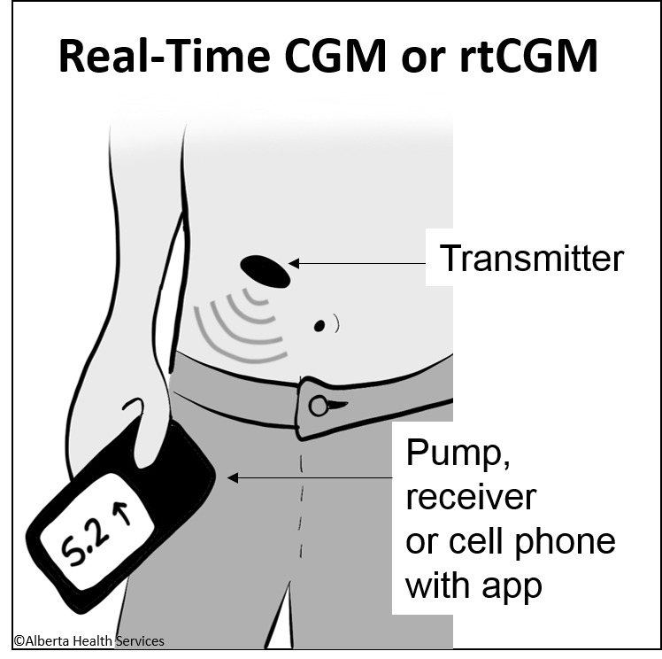 The Basics of Continuous Glucose Monitoring (CGM) - Diabetes Educators ...